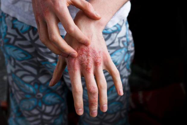 A63 | Колие за възрастни от лешниково дърво SKIN Псориазис, екзема, акне