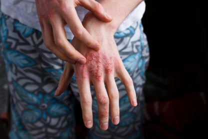 A63 | Колие за възрастни от лешниково дърво SKIN Псориазис, екзема, акне